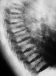 spinal x ray